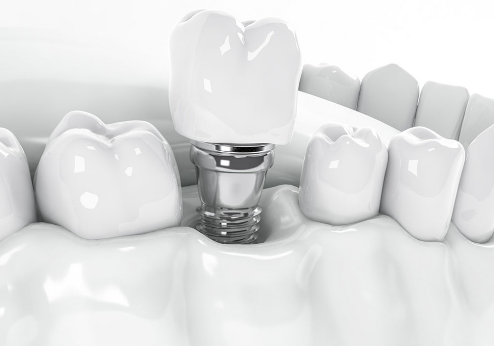Implante