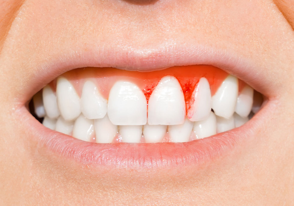 Periodoncia